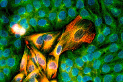 Image: Immunofluorescent Light Micrograph of melanoma cancer cells invading the skin epithelium, seen in a culture preparation (photo courtesy Nancy Kedersha / Immunogen).